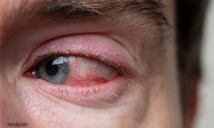 You are currently viewing Allergic Conjunctivitis Market Size and Share Report 2024-2032