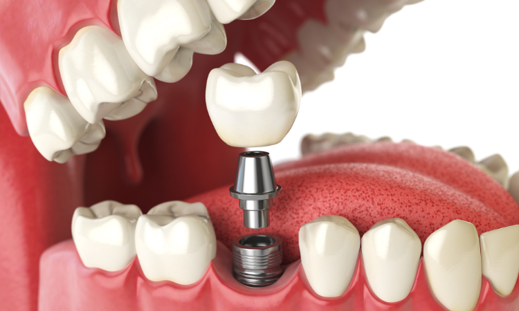 Read more about the article Dental Implants Market Share and Size Forecast Report 2024-2032