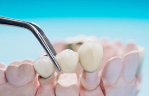 Read more about the article Dental Bridges: Understanding the Pros and Cons