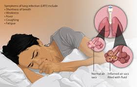 Read more about the article Typical symptoms of bacterial respiratory tract infections