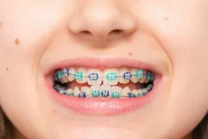 Read more about the article Get Perfect Teeth with Dental Braces mascot – Straighten Smile Today