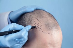 Read more about the article 2024 Hair Transplant Cost in Dubai: Full Breakdown