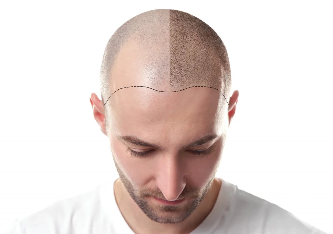 You are currently viewing How Much Does Hair Transplant Cost in Dubai?