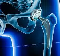 Read more about the article Hip Replacement Market Size Forecast Report 2024-2030