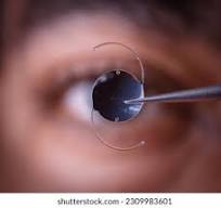 Read more about the article Intraocular Lens Market Size Forecast Report 2024-2032