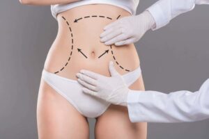 Read more about the article 7 Things to Consider Before Liposuction Surgery in Dubai