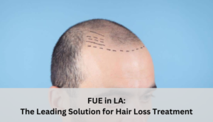 Read more about the article FUE in LA: The Leading Solution for Hair Loss Treatment