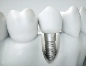 Read more about the article Top-Quality Dental Implants in Leichhardt | Every Smile Dental