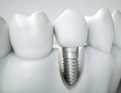 You are currently viewing Top-Quality Dental Implants in Leichhardt | Every Smile Dental