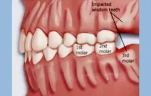 Read more about the article Act Now for Stress-Free Wisdom Teeth Removal Newtown