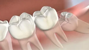 Read more about the article Effective Wisdom Teeth Removal enmore | what to Expect & Recovery Tips