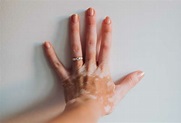 Read more about the article Global Vitiligo Market Analysis And Growth Forecast 2024-2032