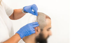 Read more about the article Expert Advice on Hair Transplant in Dubai