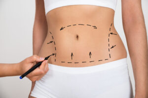 Read more about the article Beginner’s Guide to Liposuction Surgery in Dubai