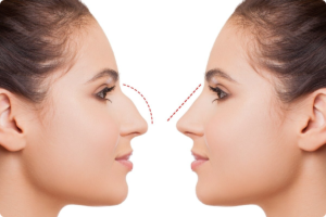 Read more about the article Beginner’s Guide to Rhinoplasty in Dubai 2024