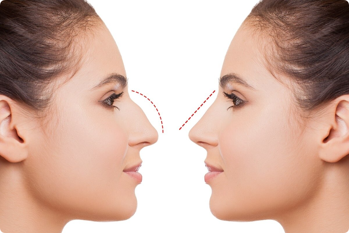 You are currently viewing Beginner’s Guide to Rhinoplasty in Dubai 2024