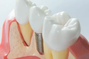 Read more about the article What to Expect with Dental Implants Alexandria