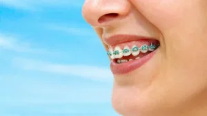 Read more about the article Perfect Smile with Dental Braces Mascot | Expert Care