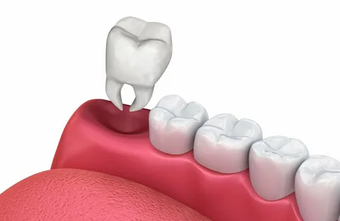 You are currently viewing Need a Tooth Extractions Alexandria? Professional Services Here