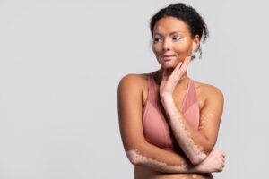 Read more about the article Say Goodbye to Uneven Skin: Your Guide to Hyperpigmentation Treatment on Cranbrook Road