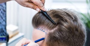 Read more about the article Beginner’s Ultimate Guide to Hair Transplant in Dubai 2024