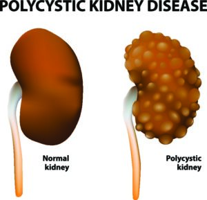 Read more about the article Polycystic Kidney Disease Drug Pipeline Analysis