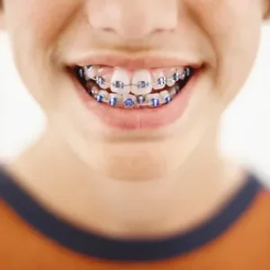 Read more about the article Expert Dental Braces Mascot: Say Goodbye to Crooked Teeth!