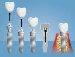 Read more about the article Tips for Post-Procedure Care for Dental Implants Mascot