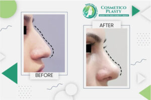 Read more about the article Factors Affecting the Nose Surgery Cost in Pakistan