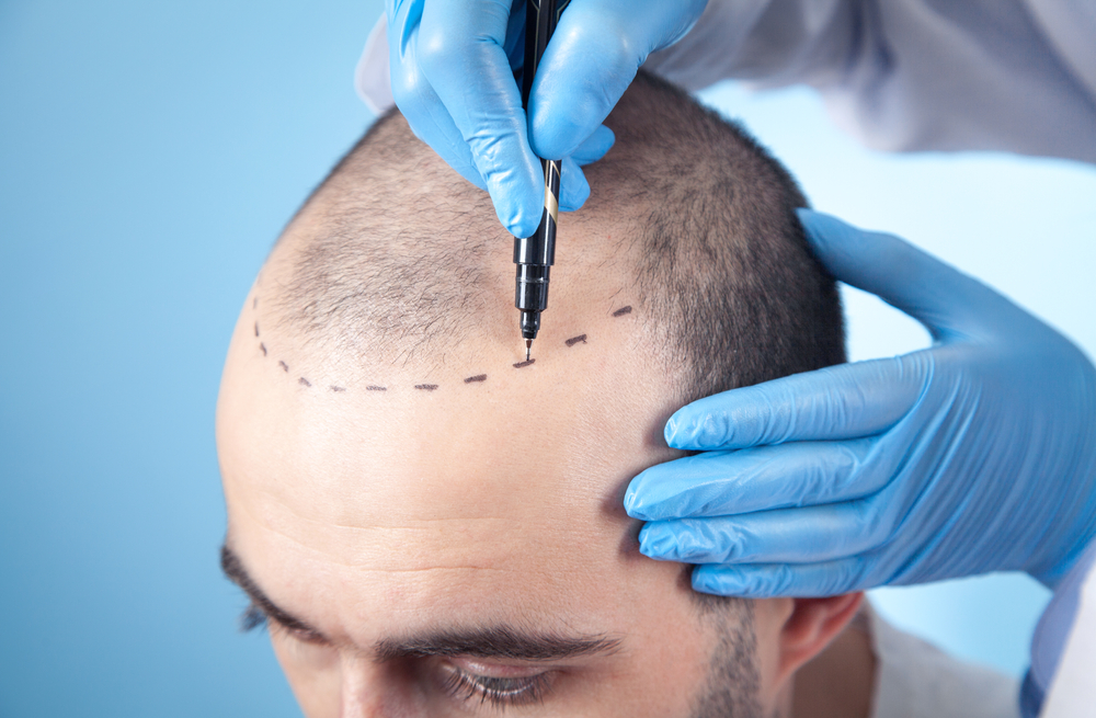 Read more about the article What determines the success of a hair transplant?