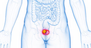 Read more about the article Globle Bladder Cancer Treatment Market, Size, Growth & Outlook | 2025-2034